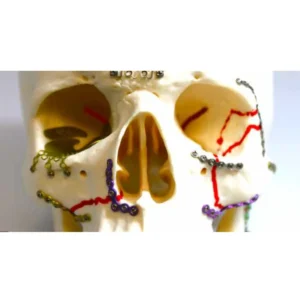 Osteosíntesis Maxilofacial Parte Media de la Cara KLS Martin Group