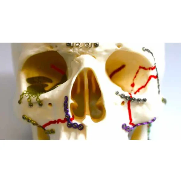 Osteosíntesis Maxilofacial Parte Media de la Cara KLS Martin Group