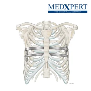 P.E.S. Pectus Excavatum System de MedExpert