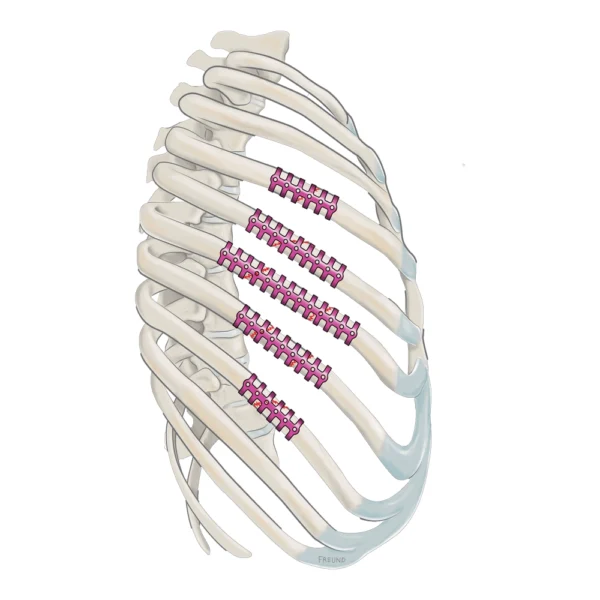 Stracos Sistema de Osteosíntesis Torácico de MedExpert