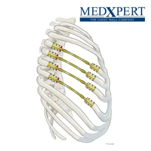 Stratos Sistema de Osteosíntesis Torácido de MedExpert