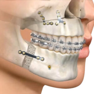 Maxilofacial